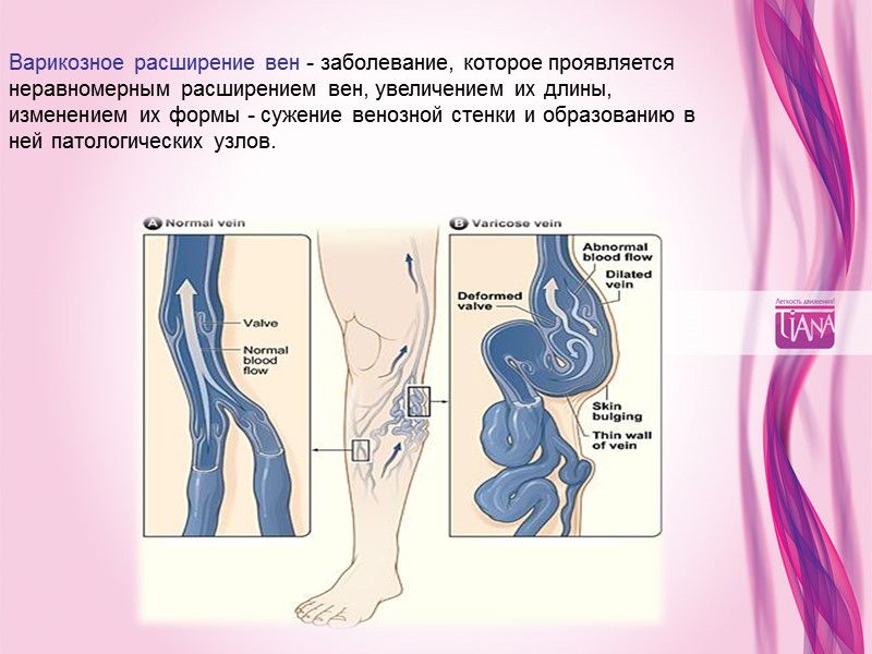 Варикозное расширение вен - заболевание, которое проявляется неравномерным расширением вен, увеличением их длины, изменением